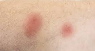 Image result for wolf spider bite skin