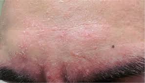 Ketoconazole cream is an antifungal agent that works against yeast. Diagnosis And Treatment Of Seborrheic Dermatitis American Family Physician