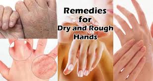 Pin By Faith Hardacre On My Rough Hands Dry Hands Dry Skin Remedies