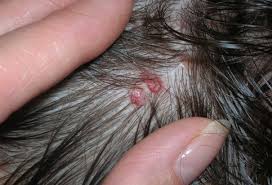 When it affects the scalp, it causes hair loss because of the inflammation and irritation of hair follicles. Is Itchy Scalp Cause Hair Loss