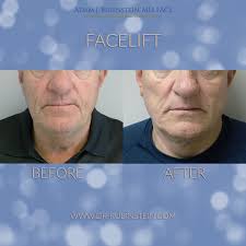 Facelifts are one of the most common procedures for men, and you can see  here just how refreshing they can be. #cosmeticsurgery #facelift  #plasticsurgery