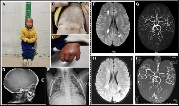 Frontiers | Hutchinson-Gilford progeria syndrome complicated with stroke: A  report of 2 cases and literature review
