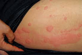 Sfatulparintilor » îngrijire bebelusi » bebeluși » urticarie la copii. Urticaria In Timpul Sarcinii Cauze Tratament È™i Remedii Naturale