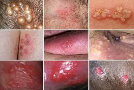 Image result for genital herpes