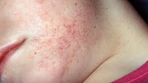 These are the skin outgrowths which are caused by bleeding and hence they normally have reddish or purplish brown coloration. Leukemia Rash Pictures Signs And Symptoms Everyday Health