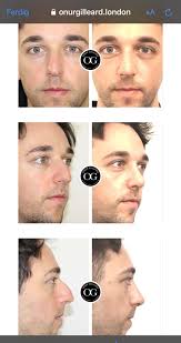 Sam's nose job : r/LoveIsBlindUK