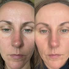How to improve skin texture and reduce pores?