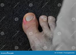 Image result for Paronychia feet