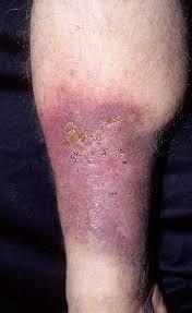 Image result for Lipodermatosclerosis