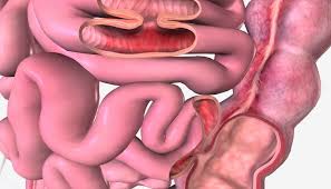 Not to be confused with the death metal band fistula from st. Gastrointestinal Fistula Causes Treatment And Complications