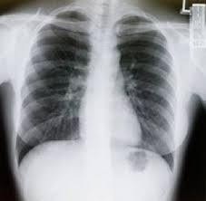 Image result for lung cancer xray