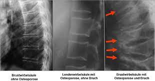 Knochendichtemessung Arthrose Muss Kein Schicksal Sein Praxis Dr Med Pfeiffer