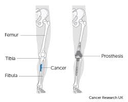 Bones give your body structure and enable you to move, but what else is your skeletal system responsible for? Limb Sparing Surgery Bone Cancer Cancer Research Uk