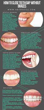 Should you fix tooth gaps? How To Fix Gap Teeth At Home Arxiusarquitectura