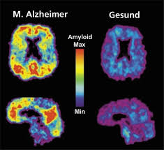 Involves parts of the brain that control thought, memory, and language. Alzheimer Offenbar Bei Op Ubertragbar