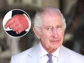Everything King Charles Said About His Famous 'Sausage Fingers ...
