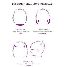 Image result for Positional Head Deformity