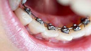 Patients must visit the orthodontist regularly — about once per month — for adjustments. Lingual Braces Pros And Cons Cost Comfort Lisping And More