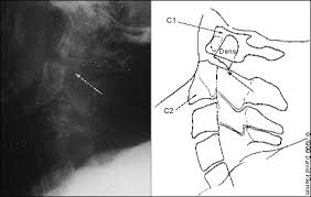 Lumbar puncture (lp), also known as a spinal tap, is a medical procedure in which a needle is inserted into the spinal canal, most commonly to collect cerebrospinal fluid (csf) for diagnostic testing. Cervical Spine Radiographs In The Trauma Patient American Family Physician