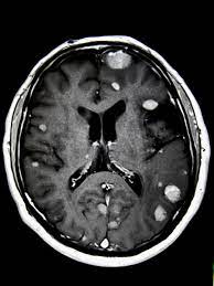 Uveal metastasis from breast cancer in 264 patients. Breast Cancer Spread To The Brain Symptoms And Treatments