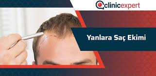 Yanlara Sac Ekimi Clinicexpert Uluslararasi Saglik Hizmetleri