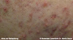 Narbencreme, narbensalbe, akne narbe entfernen creme, scar fade cream. Erfolgreich Akne Behandeln Bodensee Laserklinik Dr Martin Braun Hautarzt Uberlingen