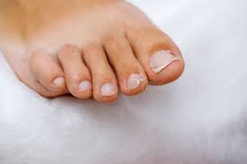 Image result for Onycholysis feet