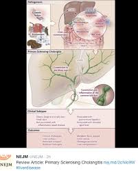 Maybe you would like to learn more about one of these? Primary Sclerosing Cholangitis 2016 Gutsandgrowth