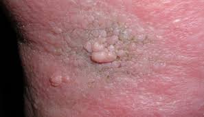 Ciuperca piciorului poate fi confundata cu keratoza punctata, o boala ce afecteaza pielea prin capatarea unui aspect de fagure de miere la nivelul zonei plantare in care pielea a fost solicitata mecanic. Limfologia Complicatiile Edemului Limfatic