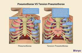 Image result for Open Pneumothorax