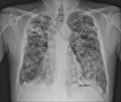 The sternum, or breastbone, is a flat bone at the front center of the chest. Chest X Ray At Hospital Admission Showing Areas Of Old Download Scientific Diagram