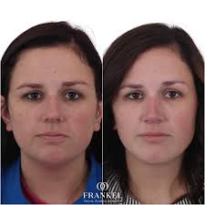 Frankel Facial Plastic Surgery, LLC: Jonathan Frankel, MD added a new photo  — in Cleveland,...