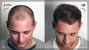 Scar Fue Hair Transplant