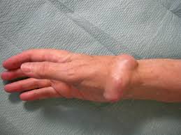 Hand Tumor Und Tumorahnliche Veranderungen Roland Klinik