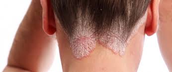 O tratamento da psoríase depende de factores como a extensão das lesões, a localização, a resposta a tratamentos prévios, a idade, o. Psoriase Couro Cabeludo