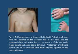 Poland's syndrome, poland's syndactyly, poland sequence, poland's anomaly, unilateral defect of pectoralis major and syndactyly of the hand1. Poland Syndrome Hand