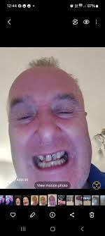 My teeth before and after