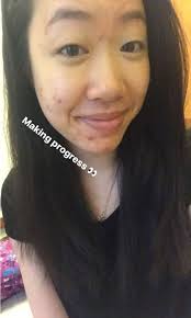 Mặt đầy mụn sưng đỏ, cô nàng này đã thay đổi rõ rệt sau khi thử dùng dầu  tràm trà trong 1 tuần