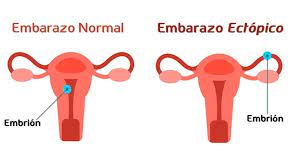 Embarazo Ectopico Signos Tratamientos Riesgos Y Sintomas Unisima Com