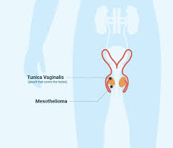 Mesothelioma occurs as one of three types of cancer cells: The 4 Types Of Mesothelioma Pleural Peritoneal Cell Types