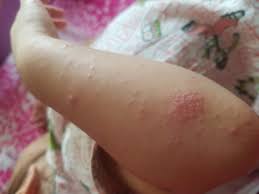 Bayi demam setelah imunisasi tentu adalah kondisi yang wajar. Petua Merawat Hfmd Dan Campak Keladi Tiny Na Sweet