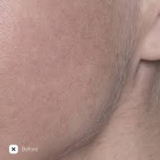 Permanent hair removal at home. New Conture Kinetic Smooth Hair Remover And Skin Polisher Bye Bye Fuzz