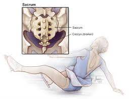 Tailbone Pain Coccydynia Causes Treatment Pain Relief