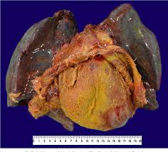 The condition can have a number of causes, including bacterial or viral infection, parasites, or fungus. Pdf Bread And Butter Fibrinous Pericarditis Semantic Scholar