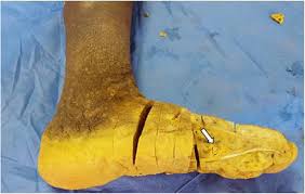 Authored by dr laurence knott, reviewed by dr helen huins. Mycetoma In A Non Endemic Area A Diagnostic Challenge Bmc Clinical Pathology Full Text