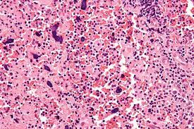 Pin On Here Is Some Information About A New Drug For Systemic Lupus Erythematosus Approved In March 2011 It S The First New Drug For Lupus In Ove