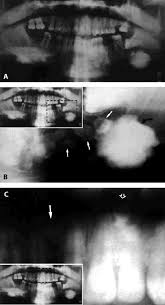 Image result for Gardner Sendromu