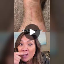 Dr. Pimple Popper Reacts to Cutaneous Larval Migrants