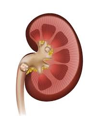 Image result for Nephrolithiasis