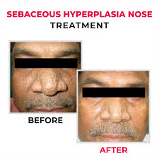 Image result for Sebaceous Hyperplasia